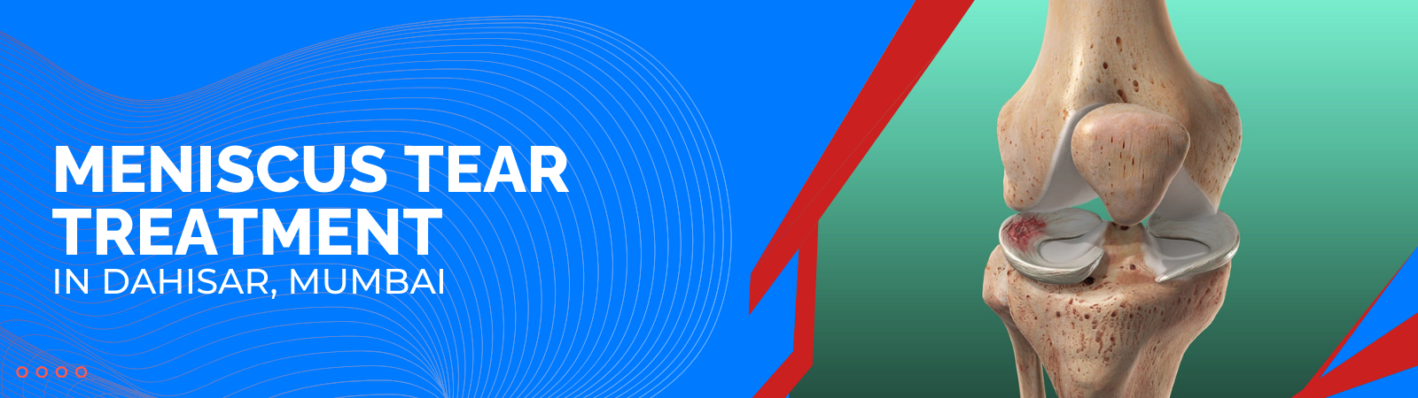 Meniscus Tear Treatment in Dahisar, Mumbai Meniscus Tear Treatment in Dahisar, Mumbai