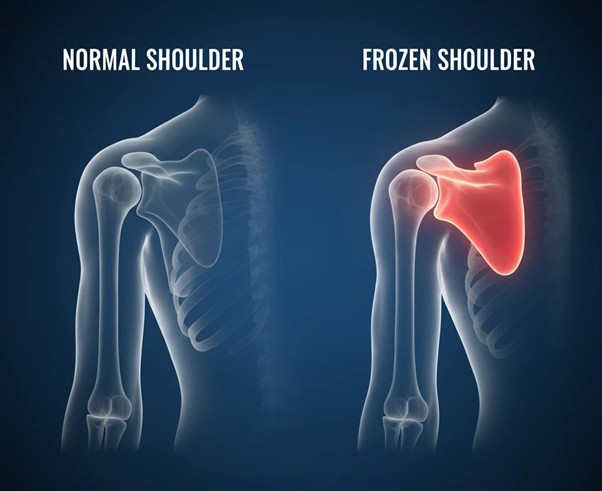 Left: soccer player injuring knee; right: older man with knee pain; circular insets show damaged knee joint cartilage and bone.