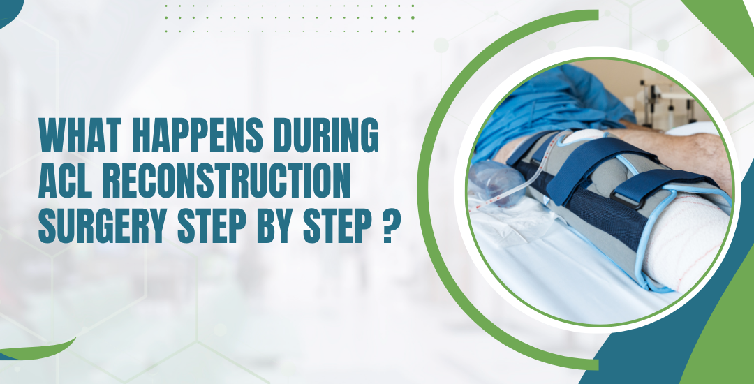 What Happens During ACL Reconstruction Surgery Step by Step?