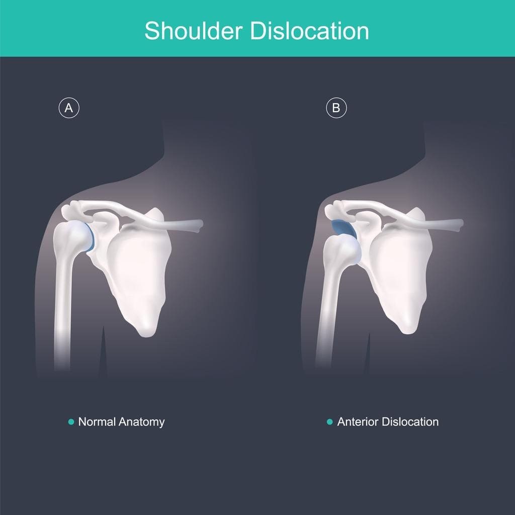 p2 Infographic showing normal shoulder anatomy (A) and anterior shoulder dislocation (B).