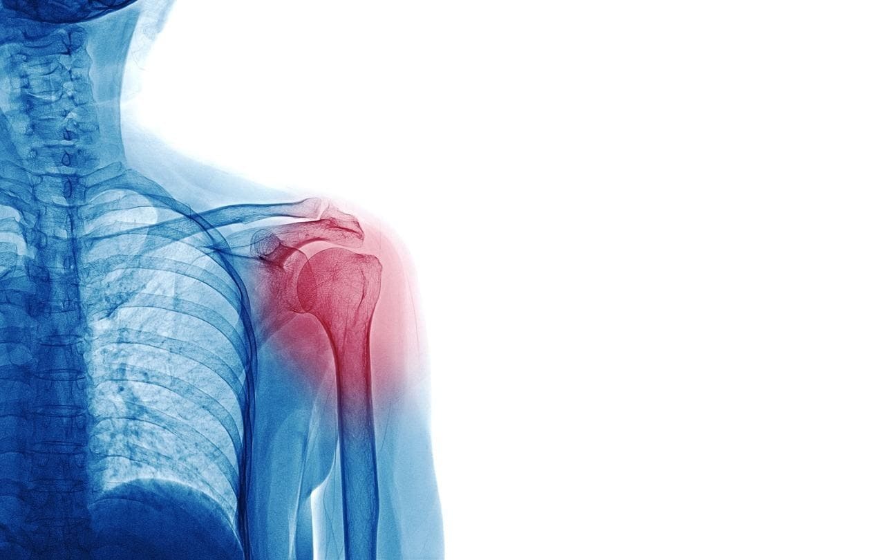p3 X-ray of a shoulder with red highlight around the joint indicating pain or inflammation.