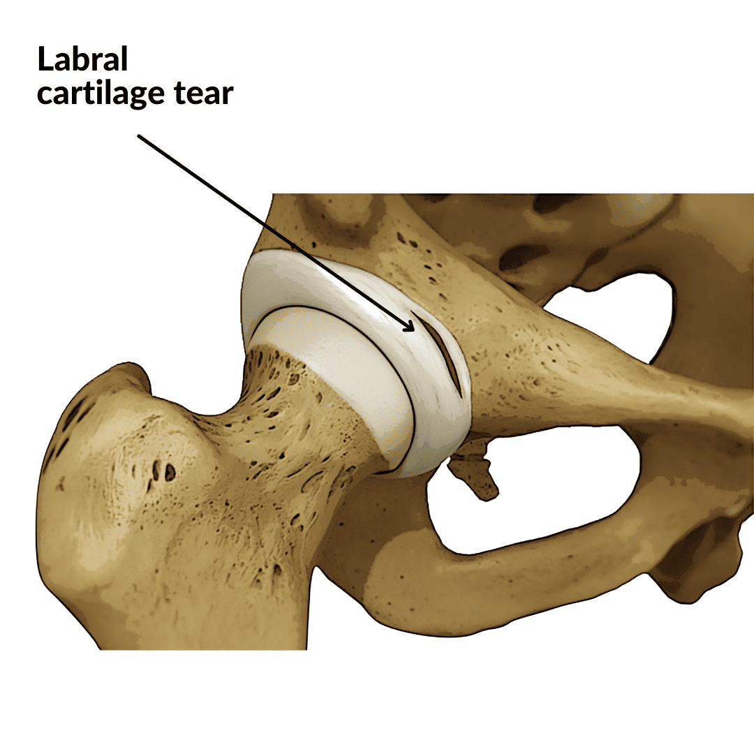 Diagram of the hip joint highlighting a labral cartilage tear in the acetabulum.