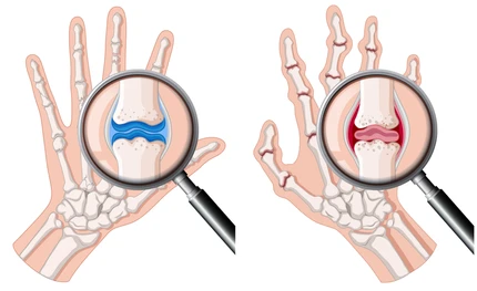 Two hands side by side; magnifying glasses highlight finger joints—left shows healthy blue cartilage, right shows inflamed red cartilage.