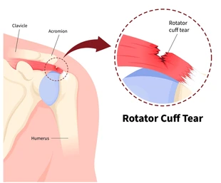 Diagram of a left shoulder showing a rotator cuff tear with a zoomed-in view of the torn tendon near the acromion? (anatomy labels: clavicle, acromion, humerus)