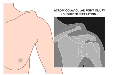 Illustration of a left shoulder with an acromioclavicular (AC) joint injury, showing a gray inset diagram of the shoulder bones and joint labeled for shoulder separation.