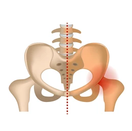 Anatomical illustration of the pelvis and lower spine with a midline reference and a red-highlighted right hip indicating pain.