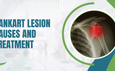 What Is a Bankart Lesion?