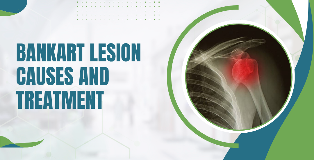 Bankart Lesion Causes and Treatment