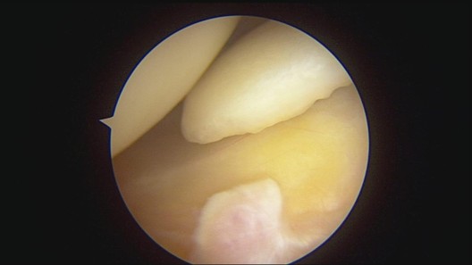 Intra-operative arthroscopic view of the right knee joint during evaluation of the ACL tear.