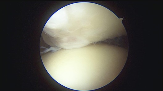 Arthroscopic view of the joint space during the procedure.